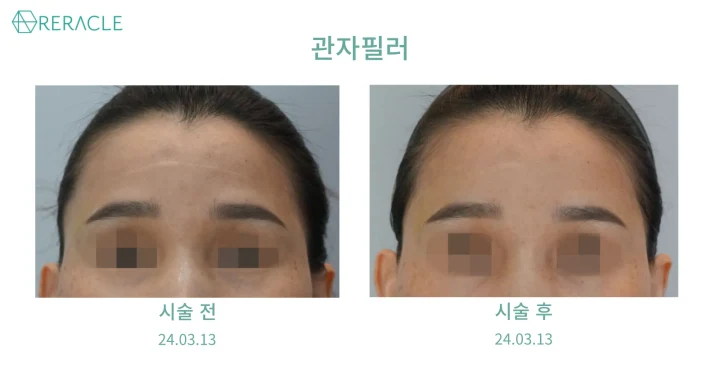 관자필러 정면 전후사진
