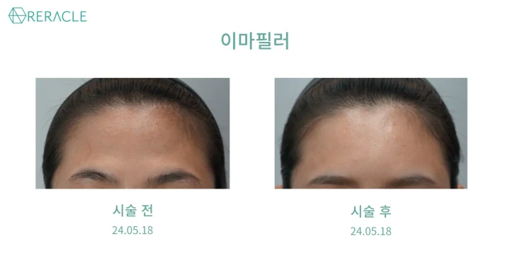 이마+관자필러 정면 전후사진