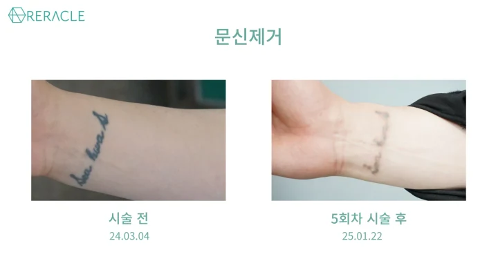 파코 문신제거 정면 전후사진