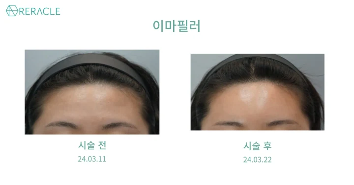 이마필러 정면 전후사진