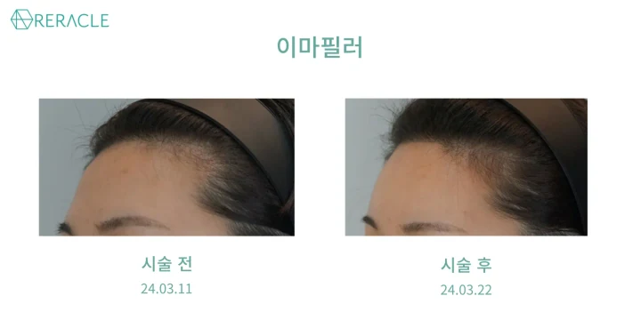 이마필러 측면 전후사진