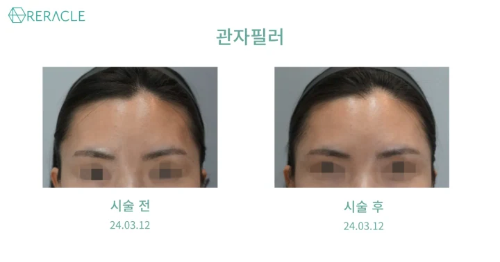 관자필러 정면 전후사진