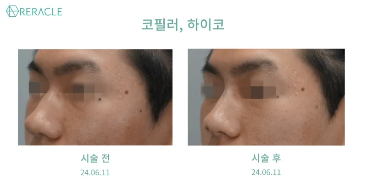 코필러+하이코 정면 전후사진