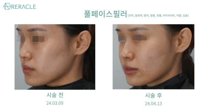 풀페이스 필러 측면 전후사진