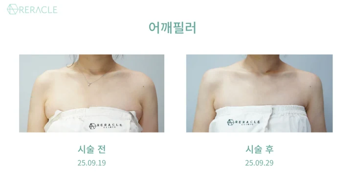 어깨필러 정면 전후사진