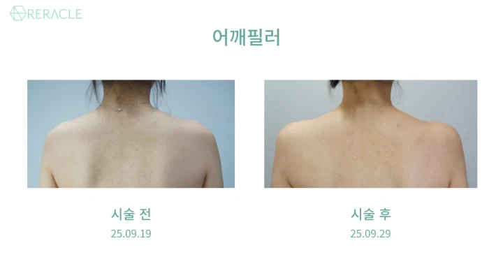 어깨필러 후면 전후사진