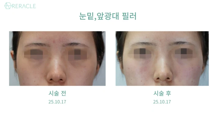 눈밑·앞광대 필러 정면 전후사진