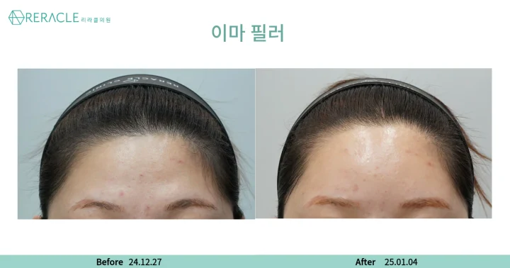 이마+관자필러 정면 전후사진