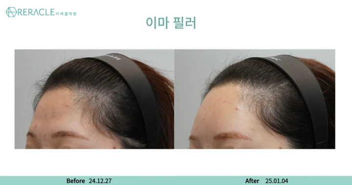이마+관자필러 45도 전후사진