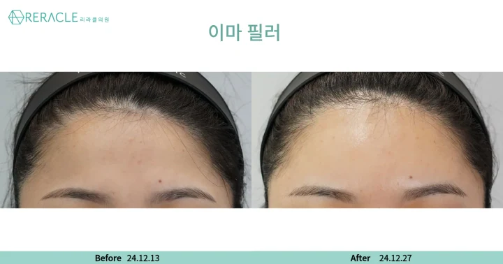 이마+관자필러 정면 전후사진