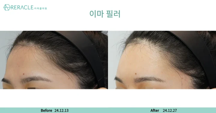 이마+관자필러 45도 전후사진