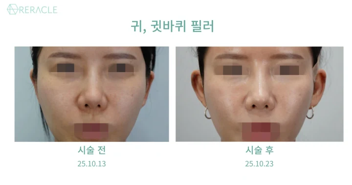 귀필러, 귓바퀴필러 정면 전후사진