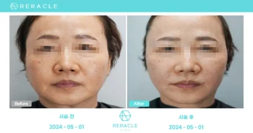 민트실리프팅 정면 전후사진