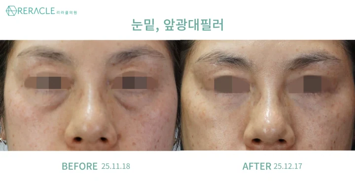 눈밑·앞광대 필러 정면 전후사진