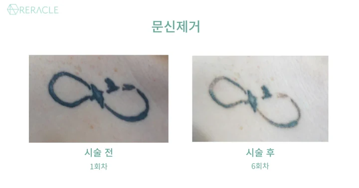 피코 문신제거 정면 전후사진