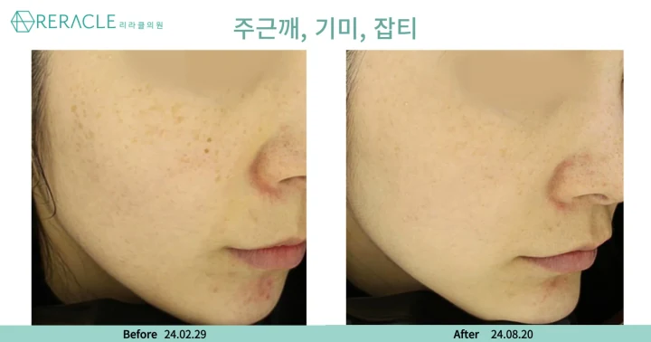 주근깨·기미·잡티 측면 전후사진