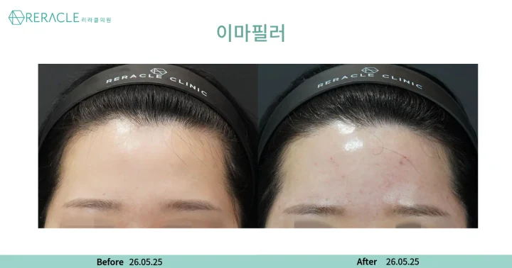 이마+관자필러 정면 전후사진