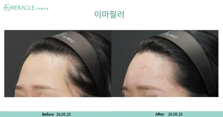 이마+관자필러 45도 전후사진