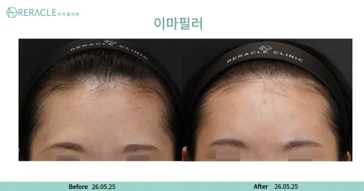 이마+관자필러 정면 전후사진