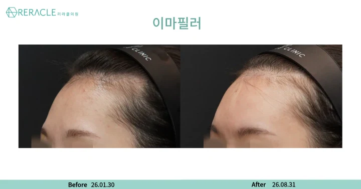 이마+관자필러 45도 전후사진