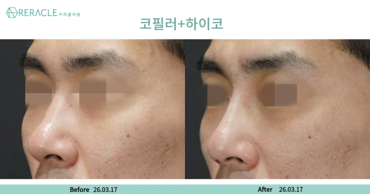 코필러+하이코 45도 전후사진