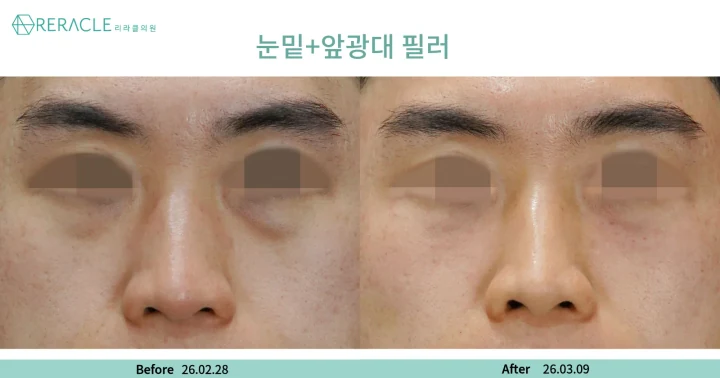눈밑+앞광대필러 정면 전후사진
