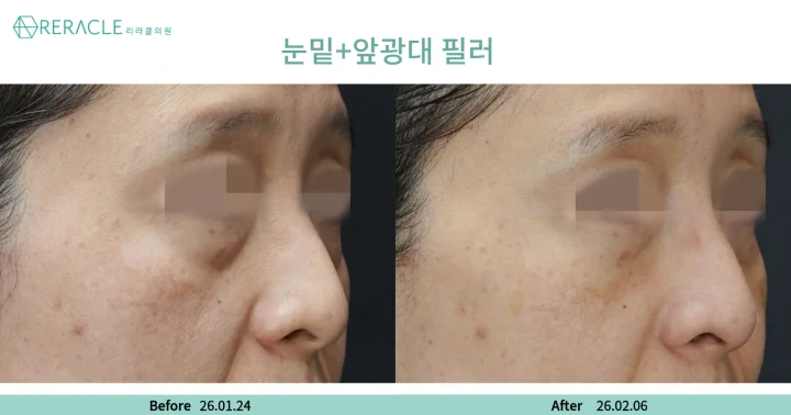 눈밑+앞광대필러 45도 전후사진