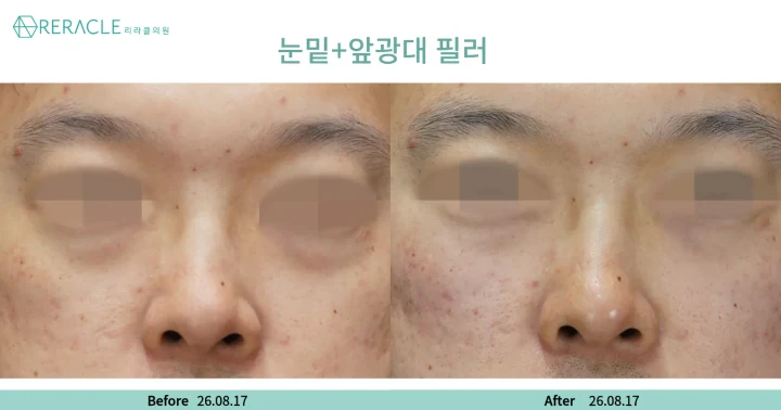 눈밑+앞광대필러 정면 전후사진
