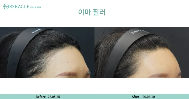이마+관자필러 45도 전후사진