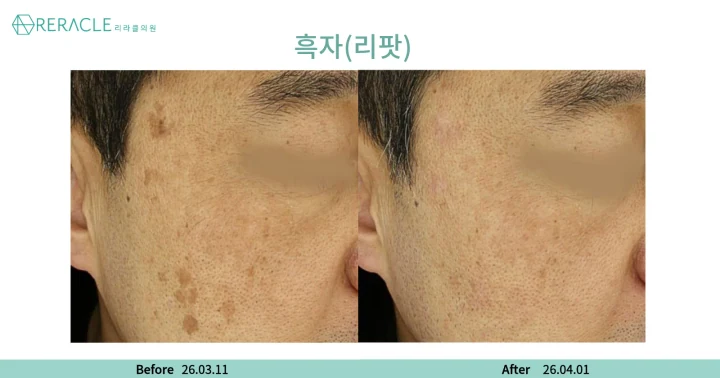 흑자(리팟) 45도 전후사진