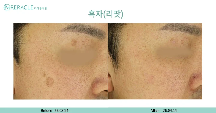 흑자(리팟) 45도 전후사진