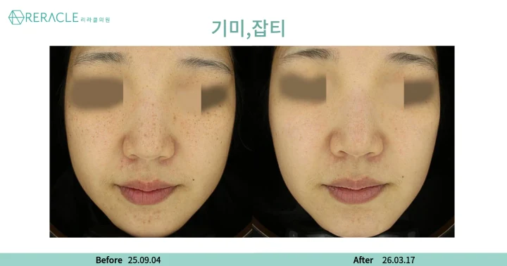 기미, 잡티 정면 전후사진