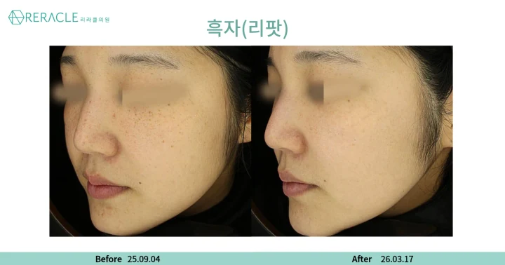 기미, 잡티 45도 전후사진