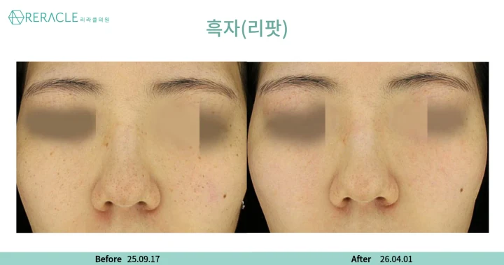 기미·잡티 정면 전후사진