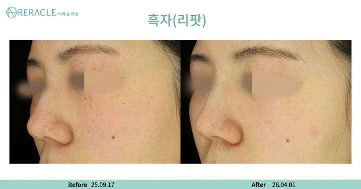 기미·잡티 45도 전후사진