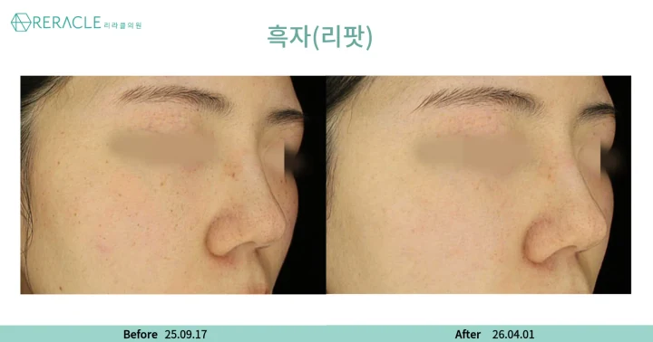 기미·잡티 45도 전후사진