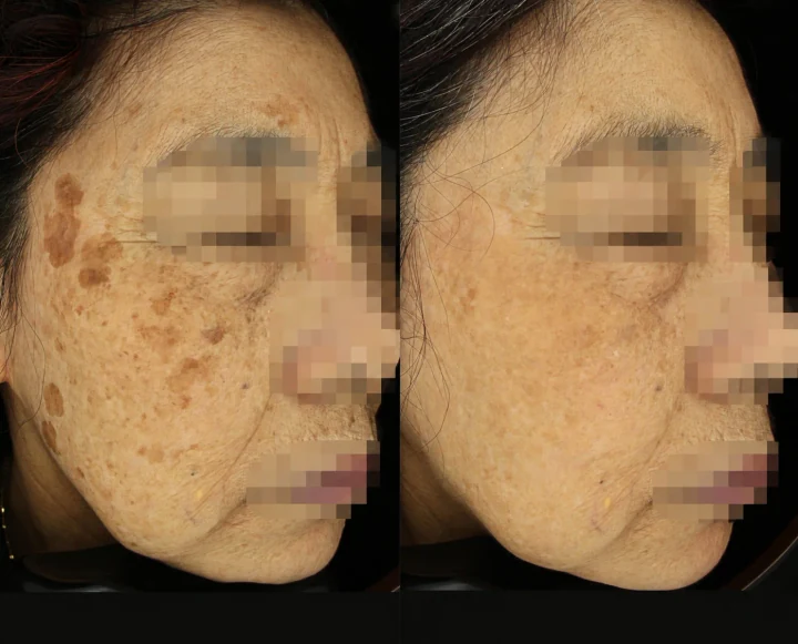 리팟 얼굴 전체 흑자 제거 45도 전후사진