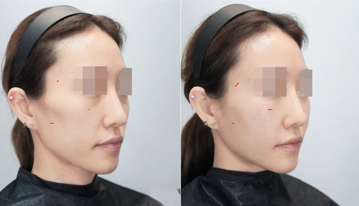 풀페이스필러 45도 전후사진