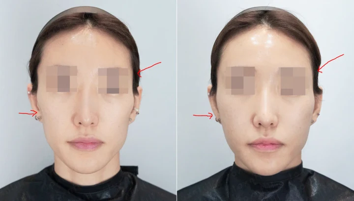 풀페이스필러 정면 전후사진