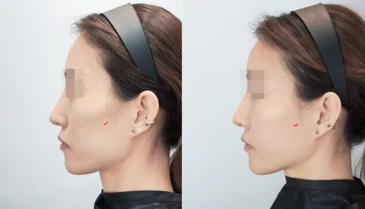풀페이스필러 측면 전후사진