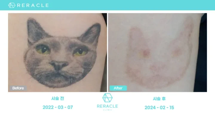 피코 문신제거 정면 전후사진