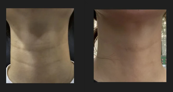 목주름 3줄에 필러 3cc를 1회 시술한 전후사진
