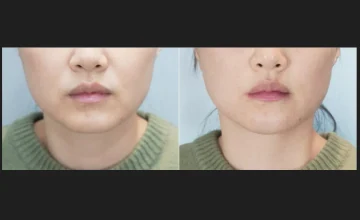 귀족·팔자 필러 전후사진