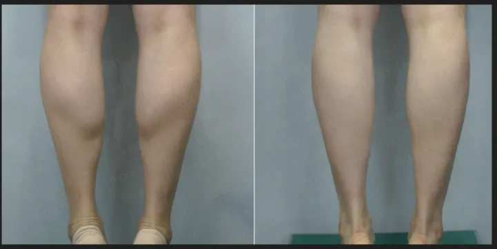 종아리 보톡스 200 유닛 전후사진