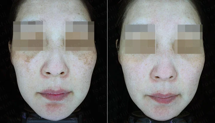 기미/잡티 정면 전후사진