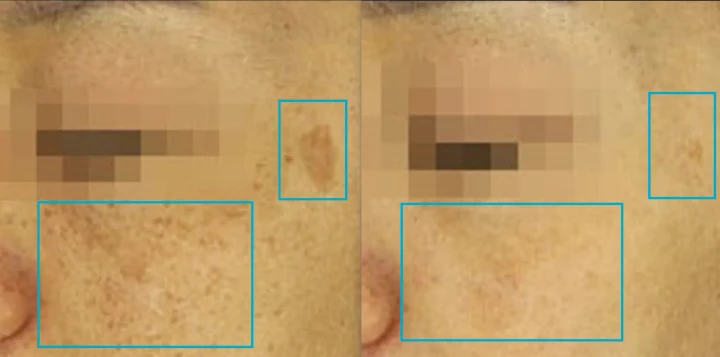 흑자+기미 초근접 전후사진