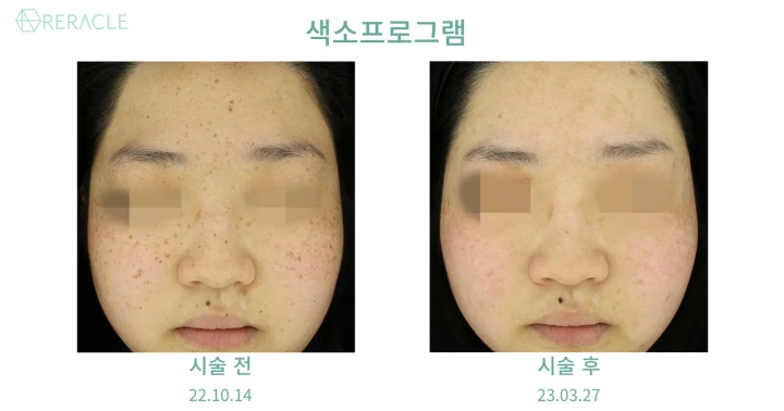주근깨 / 흑자 확대 전후사진