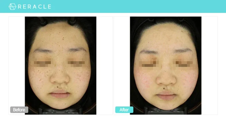 주근깨 / 흑자 정면 전후사진