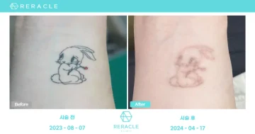피코 문신제거 정면 전후사진
