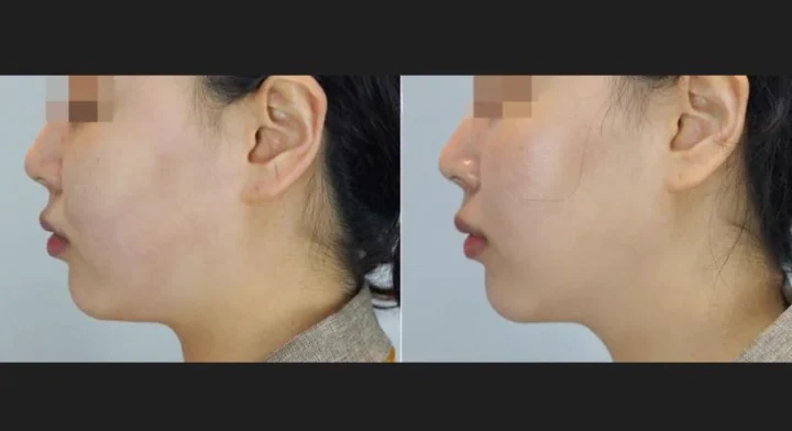 인모드 측면 전후사진
